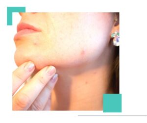 Eliminar acné en Zaragoza